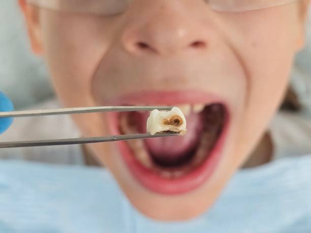 Best Emergency Root Canal Treatment in Cartervle, IL